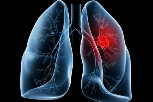 cancer-de-pulmao
