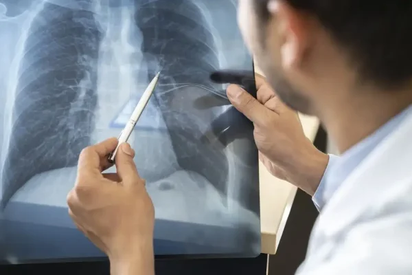 estagios-cancer-de-pulmao